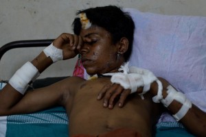 An injured victim of the deadly fire explosion that rocked the Hindu Goddess, Puttingal Devi Temple in Paravur, 60kms North-West of Thiruvananthapuram in Kerala, sleeps at the Kollam Distict Hospital, on the late evening of April 10, 2016. / AFP PHOTO / MANJUNATH KIRAN